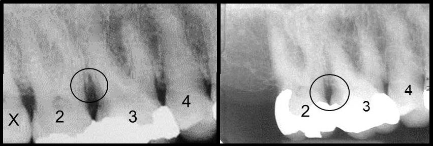 Osseous Surgery – Western Reserve Periodontics